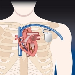 Implantable Medical Device